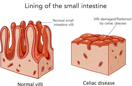 Can I Have Gluten if I’m Allergic?